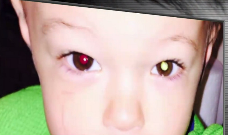 Balita terkena kanker mata