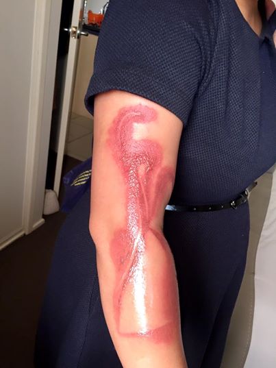 Wanita Ini Alami Luka Bakar Tingkat Dua Gara-gara iPhone 7