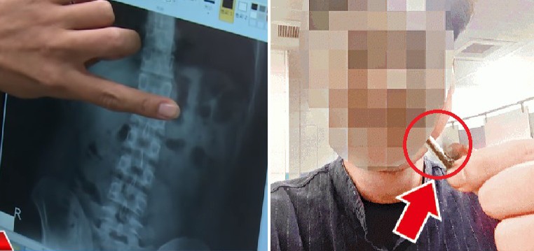 Ajaib, AirPod Masih Hidup setelah Tertelan Penggunanya