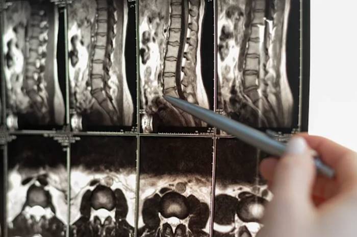 Teknologi AI Cedera Tulang Belakang