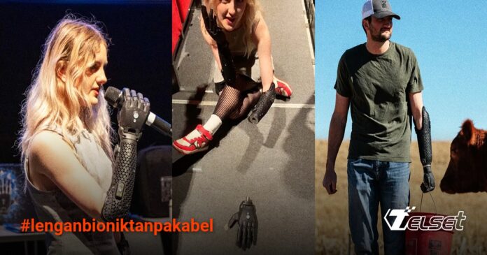 Lengan Bionik Tanpa Kabel Pertama di Dunia Bisa  Tangan bionik Hero dari Open Bionics yang sedang merangkak sendiri